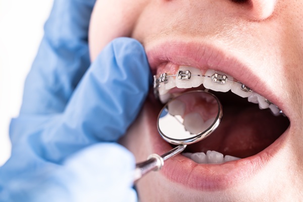 Frequently Asked Questions About Braces For Adults