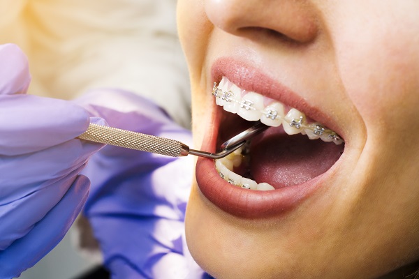 Why You Should Seek Out A Braces Specialist