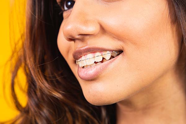 What To Know Before Getting Ceramic Braces