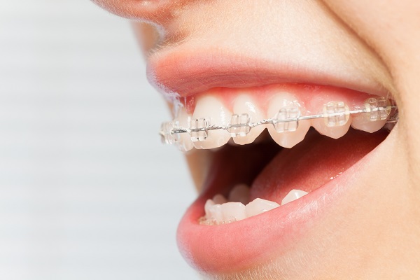 CLEAR BRACES – Welcome To Lana's Dental Care (239) 593-6488