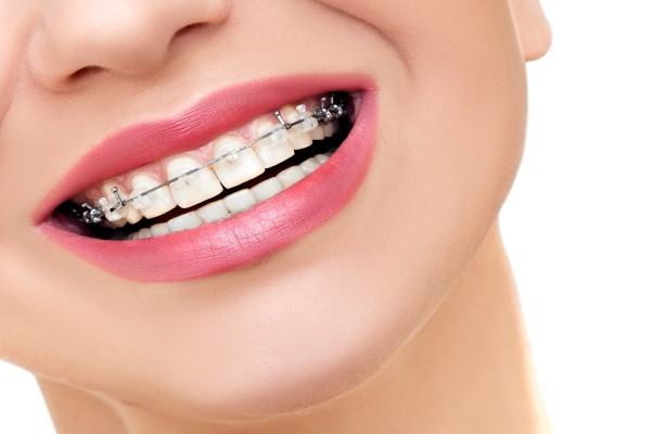 Traditional Braces Vs Clear Braces For Teens