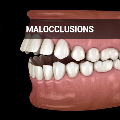 Navigation image for our Malocclusions page