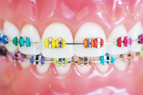 Leading Advantages Of Metal Braces