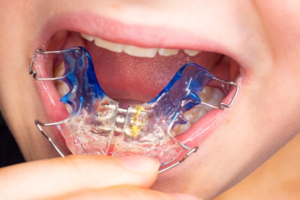 Fixed Vs Removable Retainers