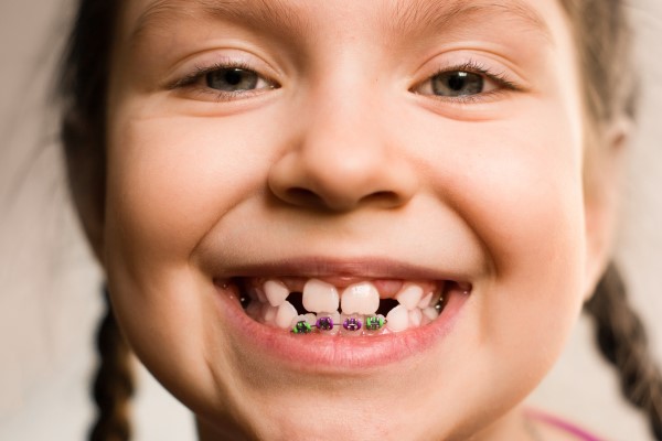 How Teeth Straightening Affects Confidence